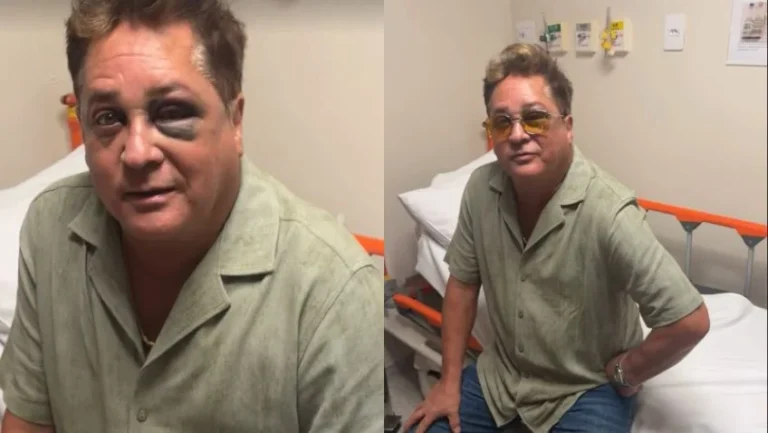 Cantor Leonardo surge com olho roxo após acidente durante pescaria no Pantanal; entenda o que aconteceu